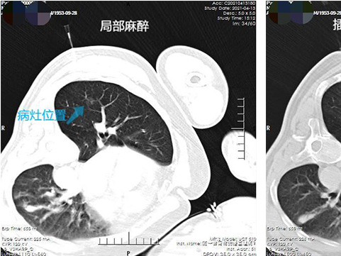 肺結節(jié)治療不開胸 射頻消融術治療效果好