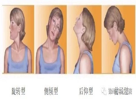 創(chuàng)新技術｜肉毒毒素治療痙攣性斜頸填補遼西地區(qū)空白