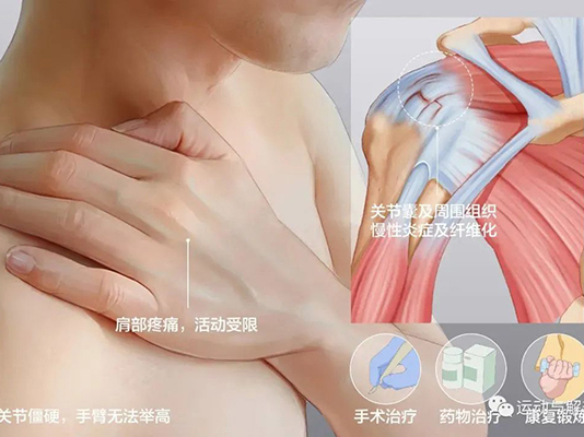 我們一起來(lái)認(rèn)識(shí)肩周炎