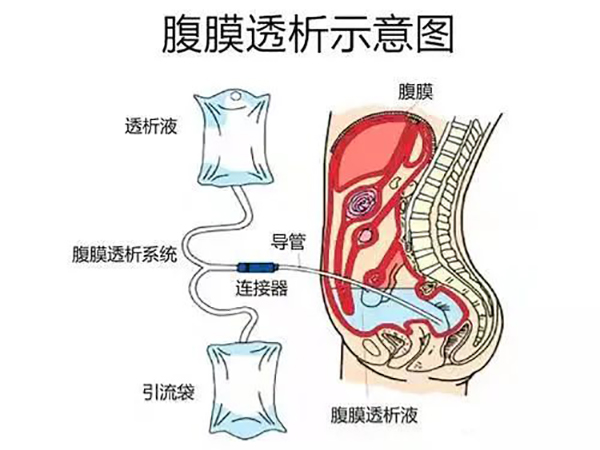堅持高質(zhì)量發(fā)展 創(chuàng)遼西腹膜透析旗艦品牌