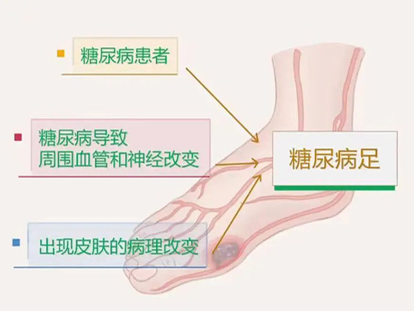 優(yōu)勢學科｜糖尿病足 預(yù)防大于治療 隨訪同樣重要
