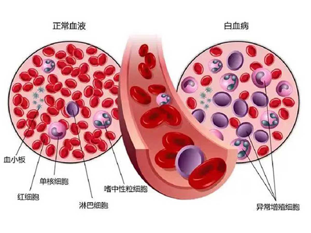 優(yōu)勢學科｜多學科合作 個體化治療 為老年高危急性髓系白血病合并壞疽性膿皮病患者帶來希望