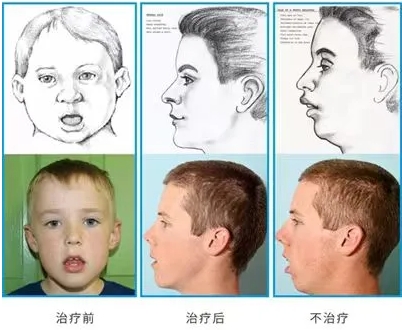優(yōu)勢(shì)技術(shù) | 兒童口腔健康及牙齒咬合 早期矯正事半功倍