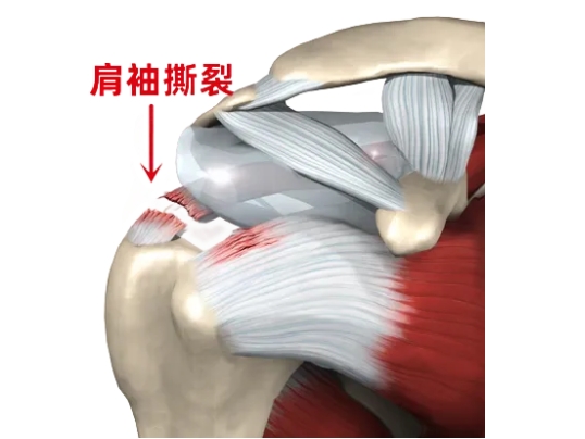 優(yōu)勢技術(shù)|肩袖損傷：肩關(guān)節(jié)鏡下縫合肩袖 小切口解決大麻煩