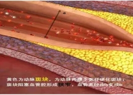 特色門(mén)診 | 頸動(dòng)脈斑塊專(zhuān)科門(mén)診