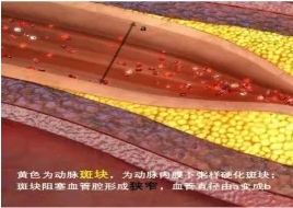 特色門診 | 頸動(dòng)脈斑塊?？崎T診