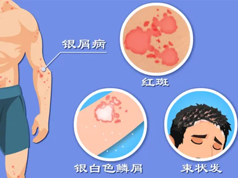 特色門診|銀屑病?？崎T診