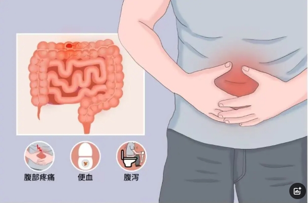 優(yōu)勢技術(shù)|消化一科運(yùn)用生物制劑治療炎癥性腸病